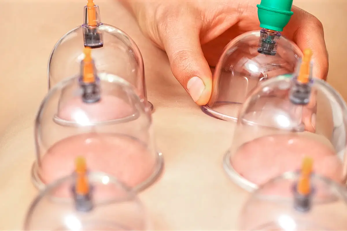 Cupping Therapy treatment