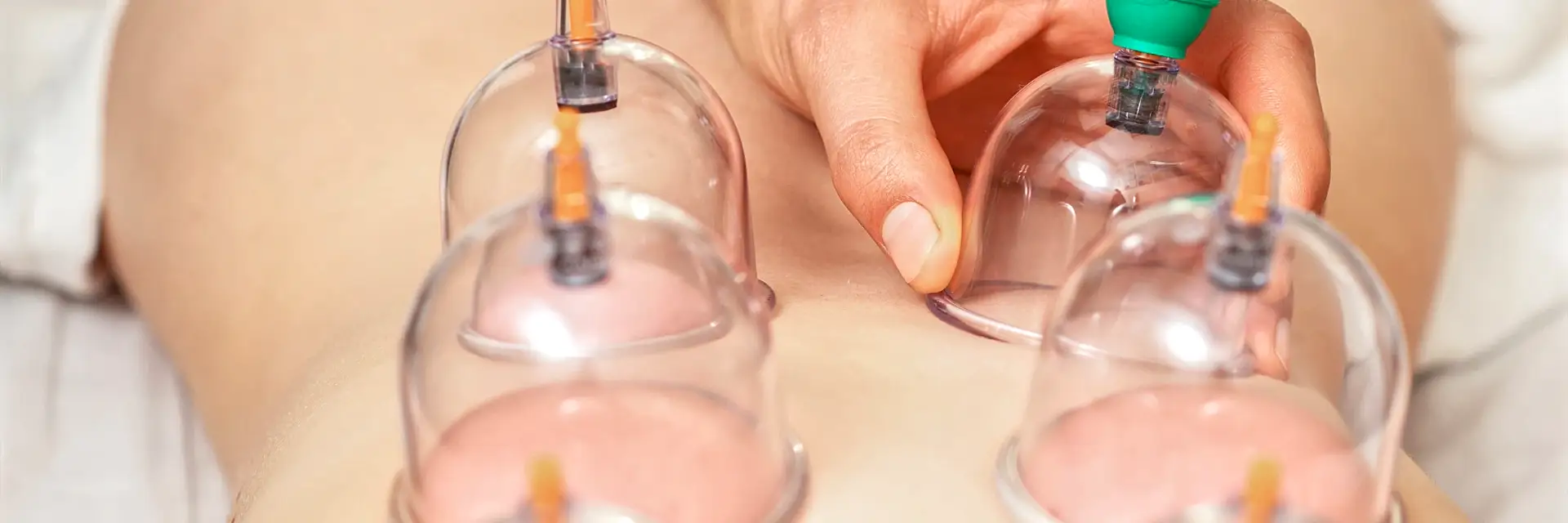 Cupping Therapy treatment